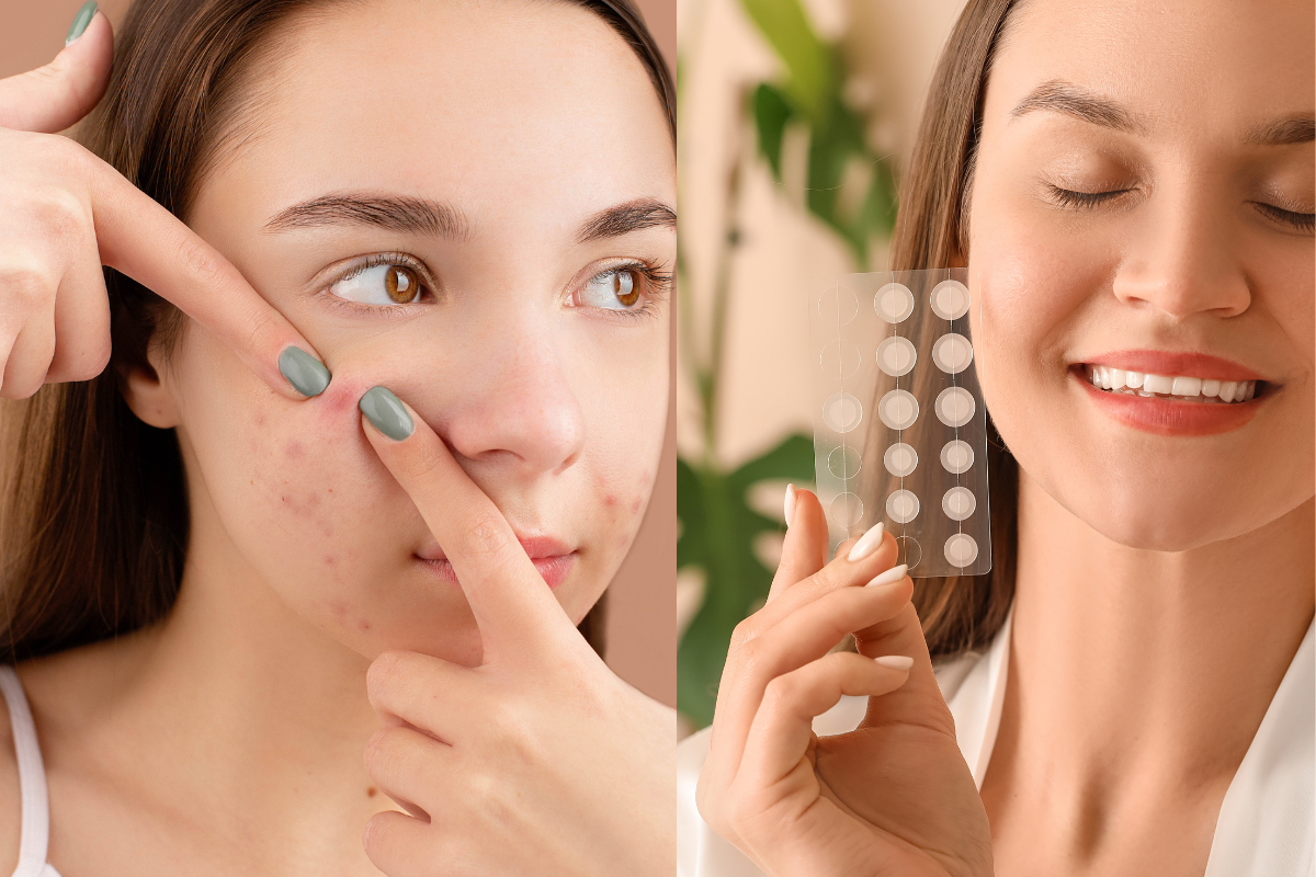 pimple patches